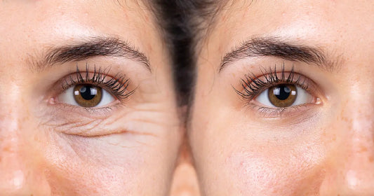 How to Combat Eye Wrinkles for a Youthful Glow